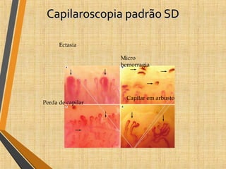 Capilaroscopia padrão SDCapilaroscopia padrão SD
a
c d
b
Figure 3| Markers of scleroderma patterns. Images obtained by routine nailfold videocapillaroscopy analysis of patients
with systemic sclerosis (magnification ×200) reveal the morphological markers of microvascular disorganization that
characterize overt systemic sclerosis and related nailfold videocapillaroscopy patterns (‘early’,‘active’ and ‘late’ systemic
sclerosis) in the presence of secondary Raynaud phenomenon. a | Giant capillaries (arrows), the earliest and most striking
morphological feature of secondary Raynaud phenomenon, are homogeneously enlarged microvascular loops that serve as
potential markers of microangiopathy. b | Microhemorrhages (arrows) result from the microvascular extravasation of red
blood cells from damaged capillaries. c | Loss of capillaries (arrows) can lead to the presence of avascular areas in the
nailfold bed and subsequent local tissue hypoxia. d | Neoangiogenesis is characterized by the clustering of twisted and
R E V I E W S
Ectasia
Micro
hemorragia
Perda de capilar
Capilar em arbusto
 
