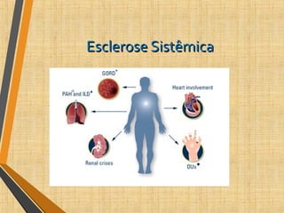 Esclerose SistêmicaEsclerose Sistêmica
 