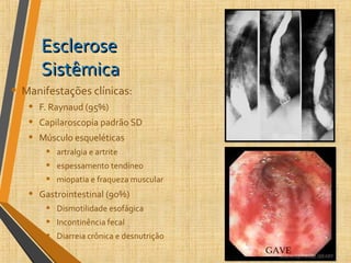 EscleroseEsclerose
SistêmicaSistêmica
• Manifestações clínicas:
• F. Raynaud (95%)
• Capilaroscopia padrão SD
• Músculo esqueléticas
• artralgia e artrite
• espessamento tendíneo
• miopatia e fraqueza muscular
• Gastrointestinal (90%)
• Dismotilidade esofágica
• Incontinência fecal
• Diarreia crônica e desnutrição
GAVE
 