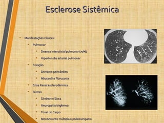 Esclerose SistêmicaEsclerose Sistêmica
• Manifestações clínicas:Manifestações clínicas:
• PulmonarPulmonar
• Doença intersticial pulmonar (70%)Doença intersticial pulmonar (70%)
• Hipertensão arterial pulmonarHipertensão arterial pulmonar
• CoraçãoCoração
• Derrame pericárdicoDerrame pericárdico
• Miocardite fibrosanteMiocardite fibrosante
• Crise Renal esclerodérmicaCrise Renal esclerodérmica
• OutrasOutras
• Síndrome SiccaSíndrome Sicca
• Neuropatia trigêmeoNeuropatia trigêmeo
• Túnel do CarpoTúnel do Carpo
• Mononeurite múltipla e polineuropatiaMononeurite múltipla e polineuropatia
 