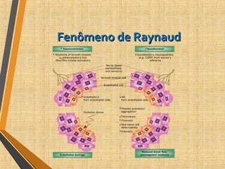 Fenômeno de RaynaudFenômeno de Raynaud
ion in Raynaud phenomenon
elaxes smooth muscle cells. In
othelial NO synthase (NOS) is
as in advanced disease, induc-
e roles of the different isoforms
ilatation are currently unclear10
on via neuronal NOS could also
16
demonstrating the interplay
eural’ abnormalities. Further
NO, in patients with SSc, the
enous inhibitor of endothelial
hylarginine—are increased.17
whether there is underproduc-
f NO in the digits of patients
disease-stage-dependent), NO
mple, via topical application of
n vasodilatation. This response
nts with SSc as in patients with
menon and healthy controls.18
on
onstrictors by endothelial cells
n-1 and angiotensin II) most
elated Raynaud phenomenon.
helin-1 is increased in sclero-
lance in the renin–angiotensin
otensin II, is thought to occur
studies implicated a role for
Nerve bres
(sympathetic
and sensory)
Smooth muscle cell
Endothelial cell
Endothelin-1
from endothelial cells
Oxidative stress
Endothelial damage
Reduced blood ow/
procoagulant tendency
NO
from endothelial cells
Platelet activation/
aggregation
Reactivity of smooth muscle
α2-adrenoceptors (via
Rho/Rho kinase activation)
Thrombin
Viscosity
Fibrinolysis
Red blood cell
deformability
Vasoconstriction Vasodilatation
Vasodilatatory neuropeptides
(e.g. CGRP) from sensor y
afferents
Figure 1 | Schematic representation of some of the key elements and
mechanisms contributing to the pathogenesis of Raynaud phenomenon. Some of
R E V I E W S
 