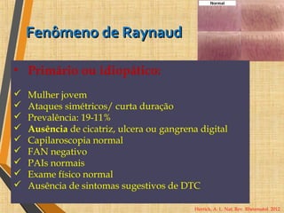Fenômeno de RaynaudFenômeno de Raynaud
• Primário ou idiopático:
 Mulher jovem
 Ataques simétricos/ curta duração
 Prevalência: 19-11%
 Ausência de cicatriz, ulcera ou gangrena digital
 Capilaroscopia normal
 FAN negativo
 PAIs normais
 Exame físico normal
 Ausência de sintomas sugestivos de DTC
Herrick, A. L. Nat. Rev. Rheumatol. 2012
 