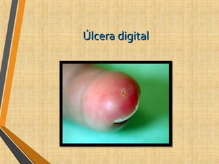 Úlcera digitalÚlcera digital
 