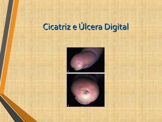 Cicatriz e Úlcera DigitalCicatriz e Úlcera Digital
 