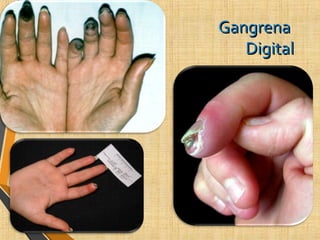 GangrenaGangrena
DigitalDigital
 