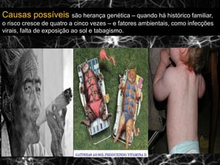 Causas possíveis são herança genética – quando há histórico familiar,
o risco cresce de quatro a cinco vezes – e fatores ambientais, como infecções
virais, falta de exposição ao sol e tabagismo.
 