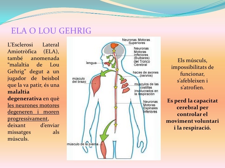 Esclerosi Lateral Amiotròfica