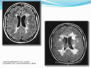 JOHN H.N OSEWORTHY, M.D., CLAUDIA
LUCCHINETTI, M.D., Volume 343 Number 13. NEJM
 