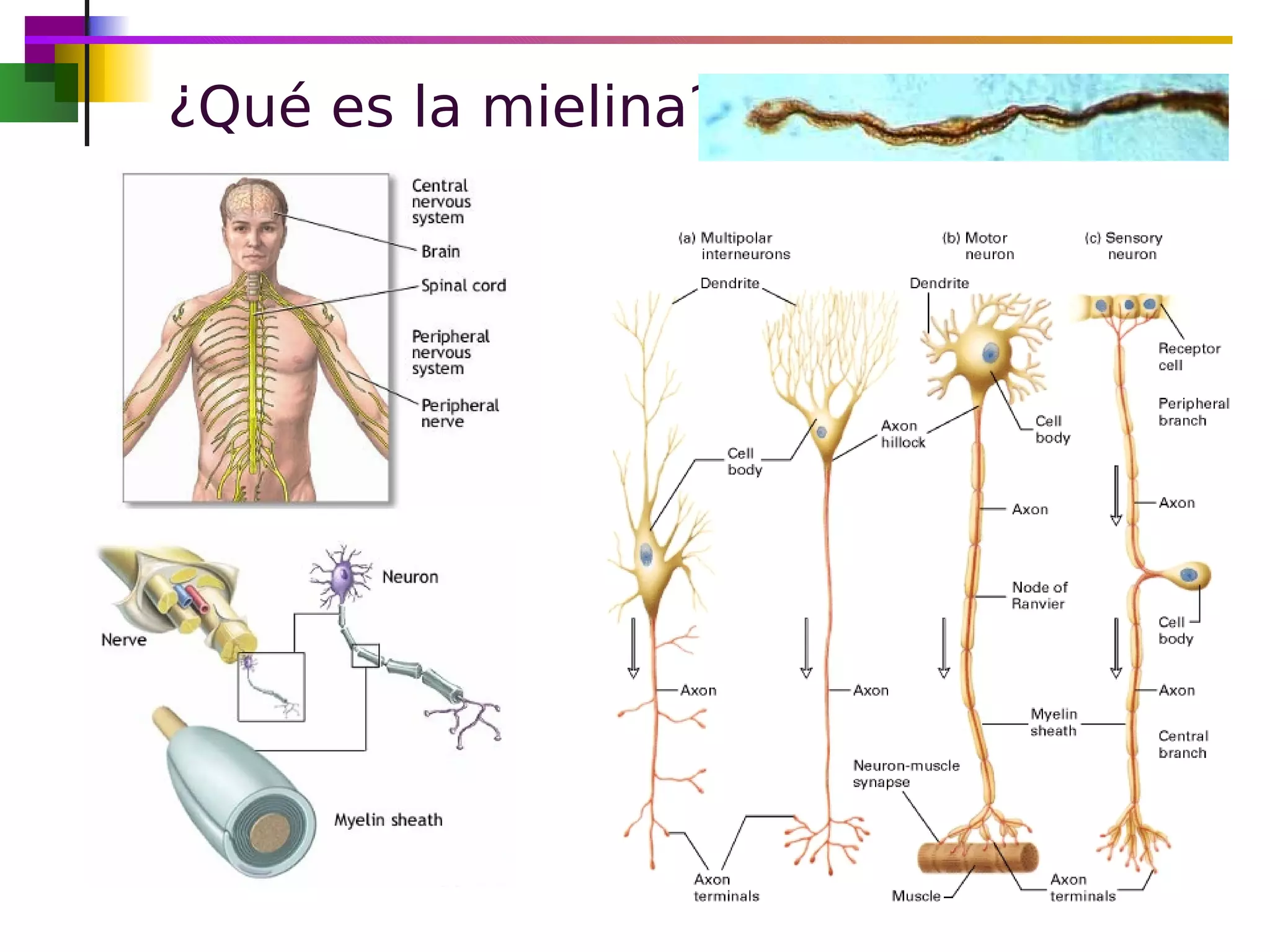 Esclerosis Múltiple