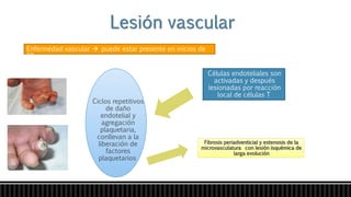 Enfermedad vascular  puede estar presente en inicios de
ES
Células endoteliales son
activadas y después
lesionadas por reacción
local de células T
Ciclos repetitivos
de daño
endotelial y
agregación
plaquetaria,
conllevan a la
liberación de
factores
plaquetarios
Fibrosis periadventicial y estenosis de la
microvasculatura con lesión isquémica de
larga evolución
 