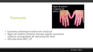 Polimiositis
• Exantema heliotropo (coloración violácea)
• Signo de Gottron (eritema macular papulo escamoso
violáceo acompañado de descamación leve)
• Articulaciones MCF y IF
(Cenetec, 2011)
 