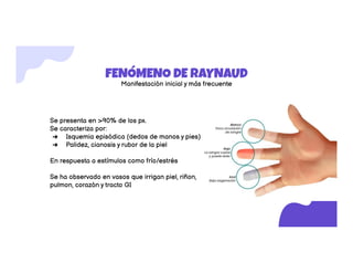 Esclerosis sistemica Con desarrollo del tema | PDF