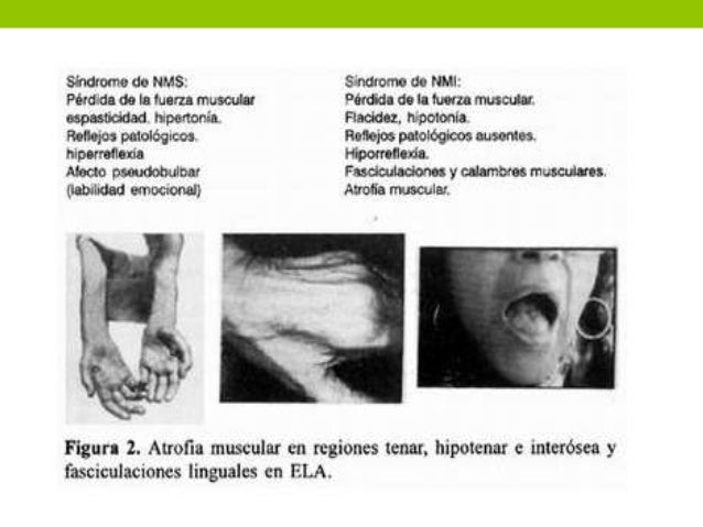 Esclerosis lateral amiotrófica