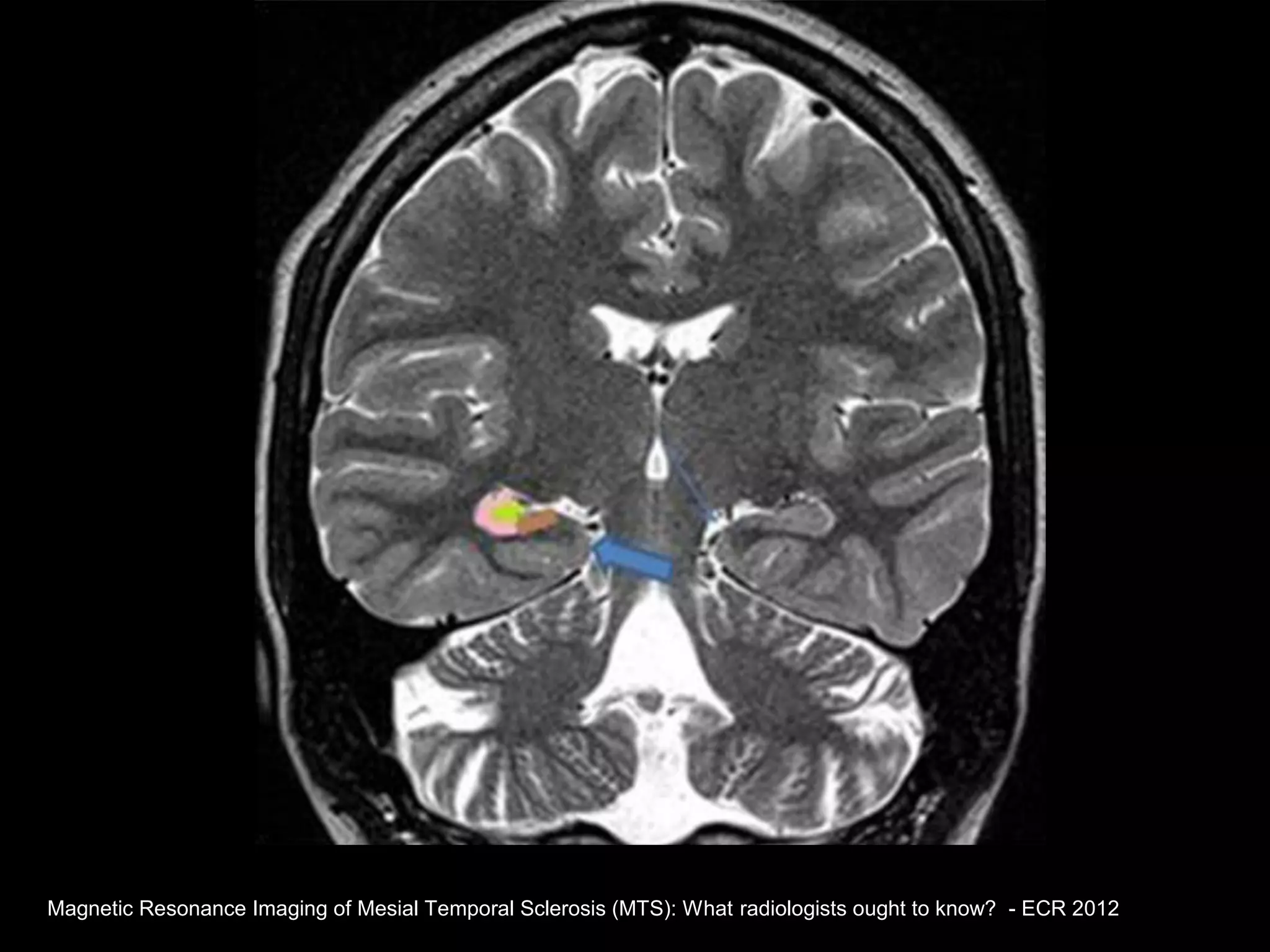 Esclerosis mesial temporal | PPT | Brain and Nervous System Disorders ...