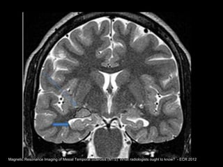 Esclerosis mesial temporal | PPT | Brain and Nervous System Disorders ...