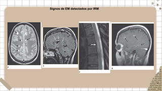 Signos de EM detectados por IRM
 