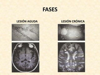 FASES
LESIÓN AGUDA LESIÓN CRÓNICA
 
