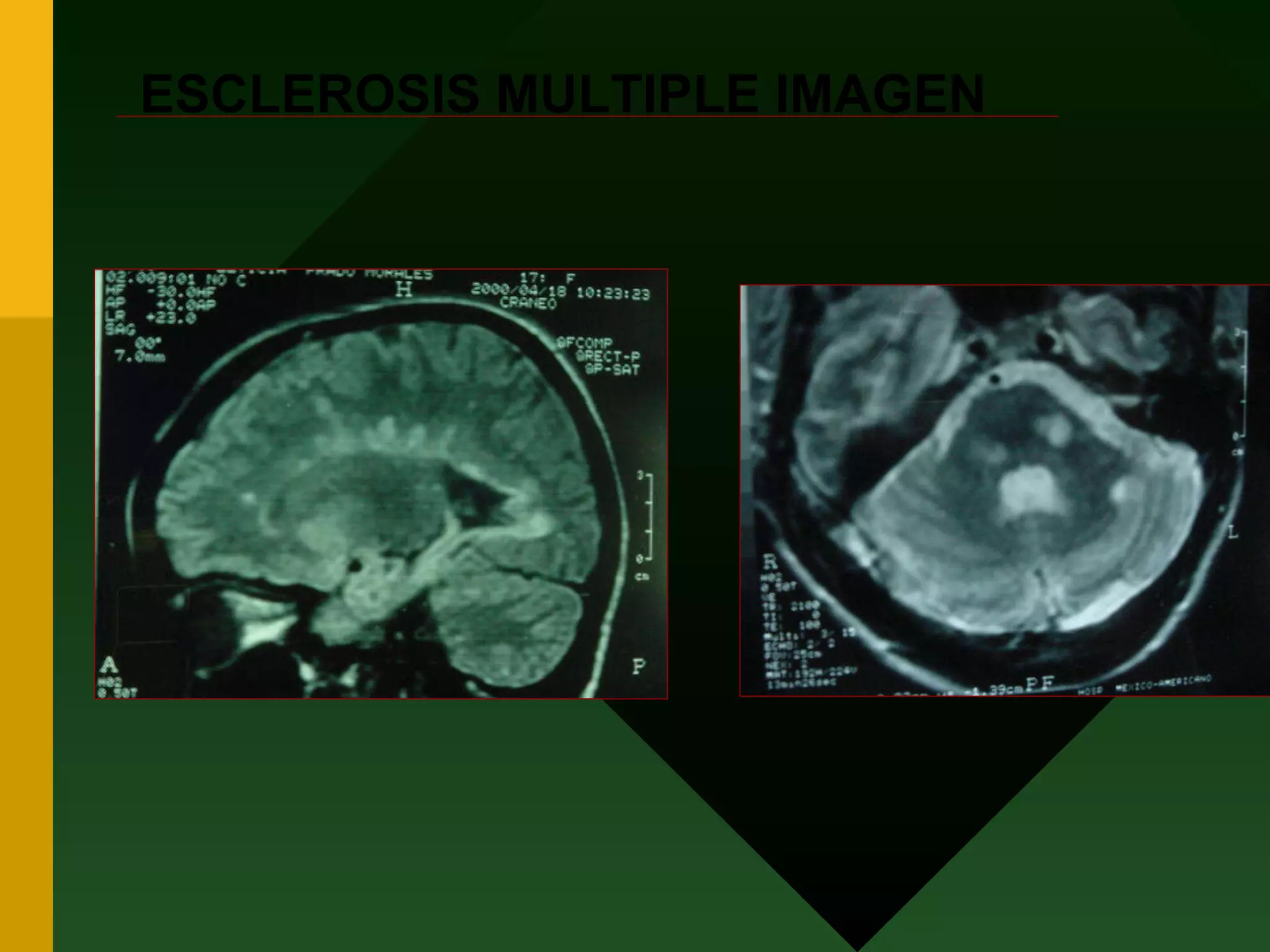 ESCLEROSIS MULTIPLE IMAGEN 