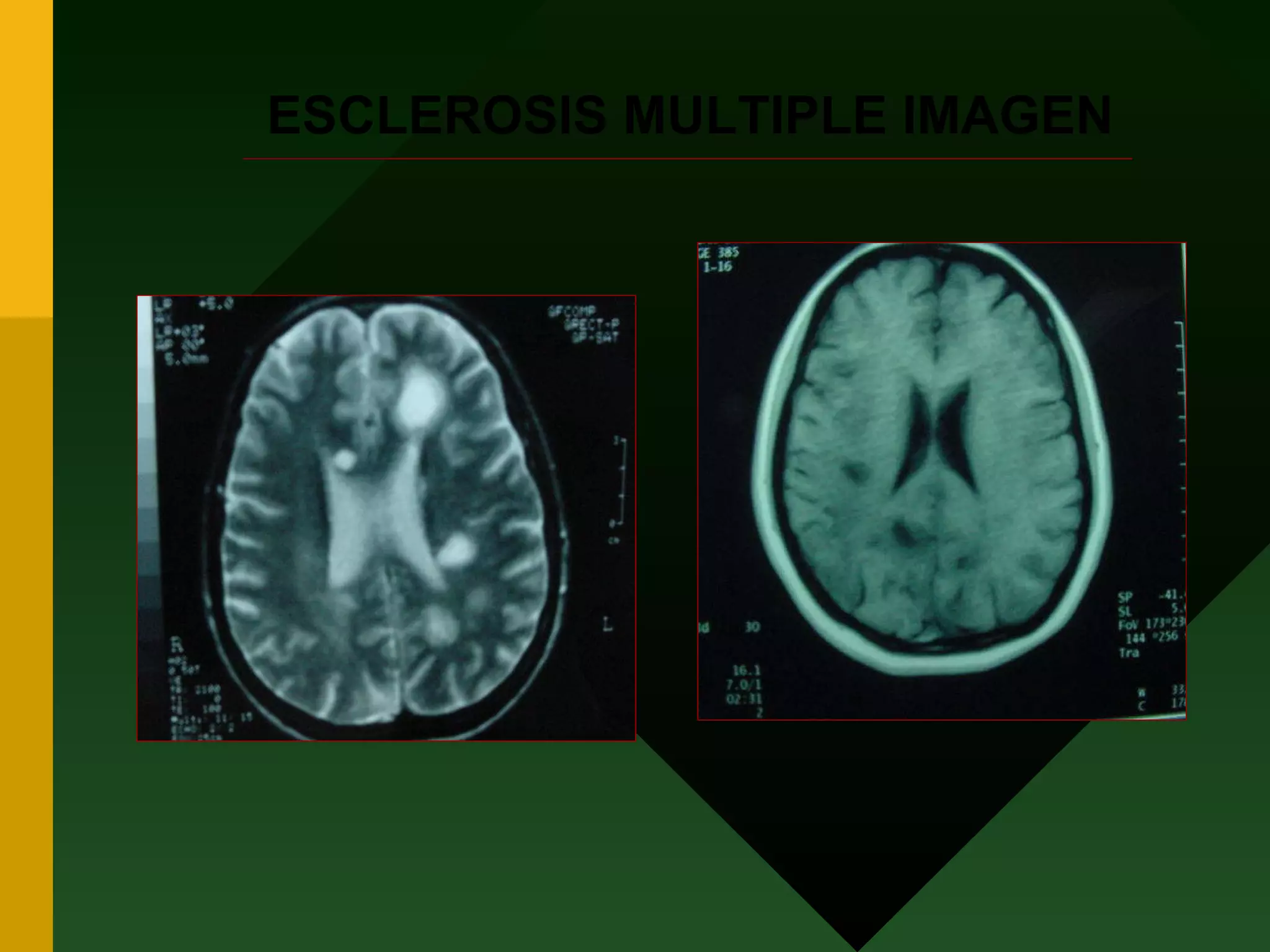 ESCLEROSIS MULTIPLE IMAGEN 