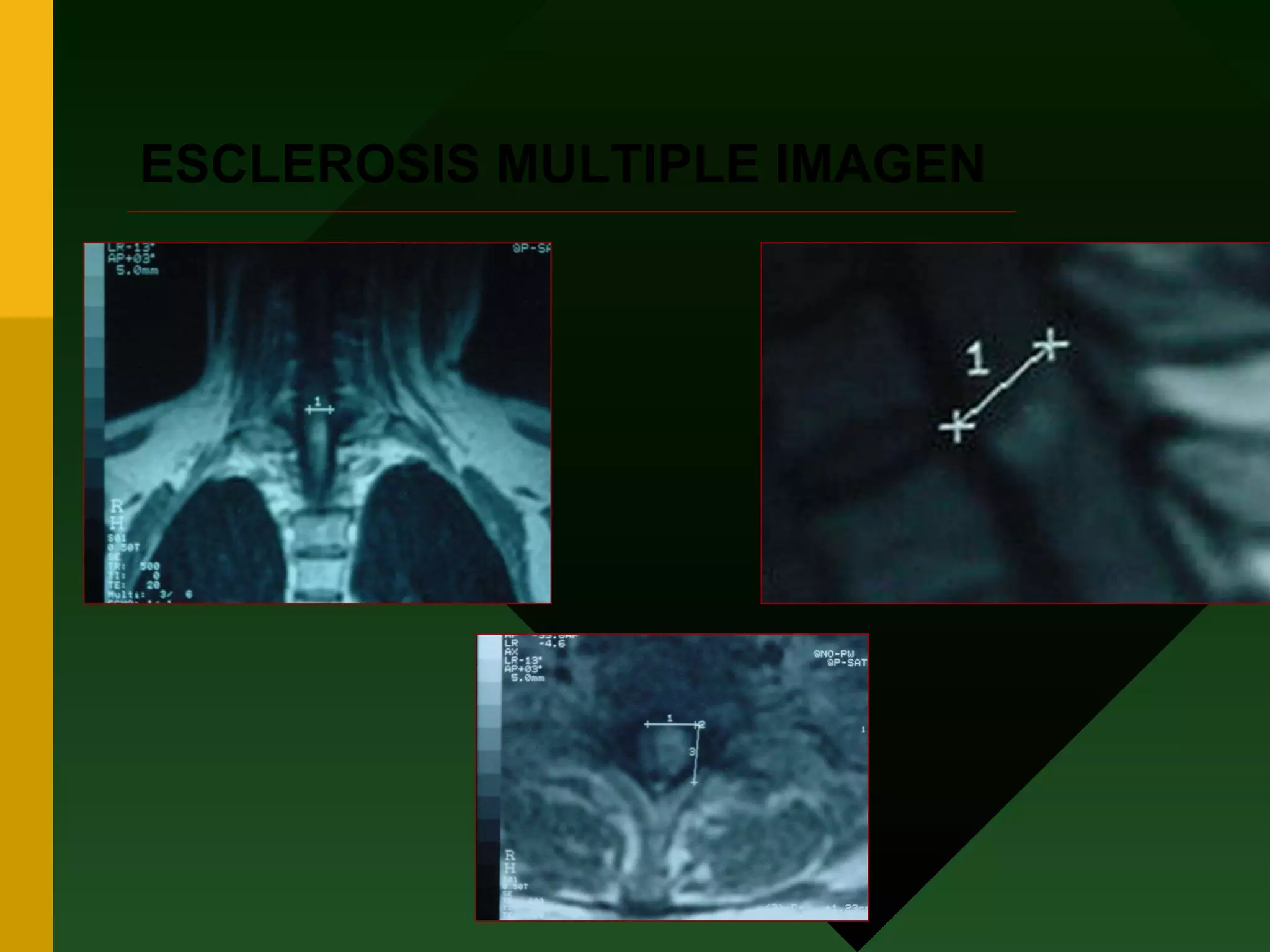 ESCLEROSIS MULTIPLE IMAGEN 