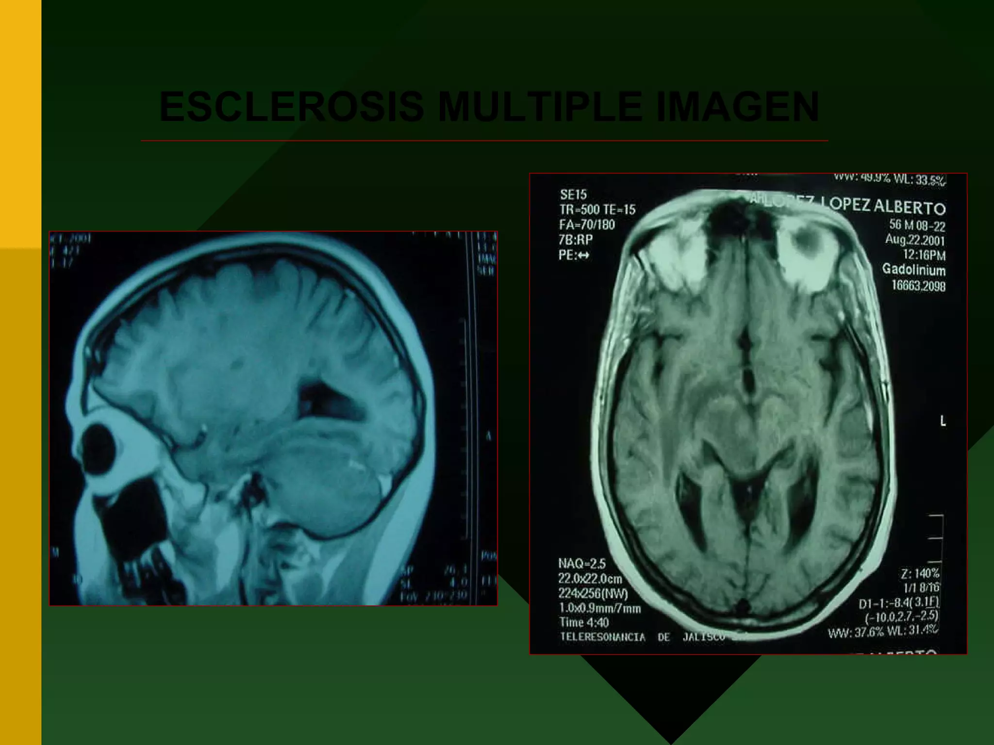 ESCLEROSIS MULTIPLE IMAGEN 