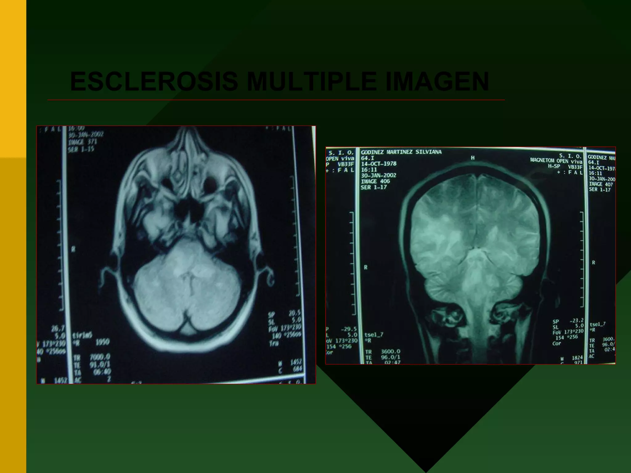 ESCLEROSIS MULTIPLE IMAGEN 