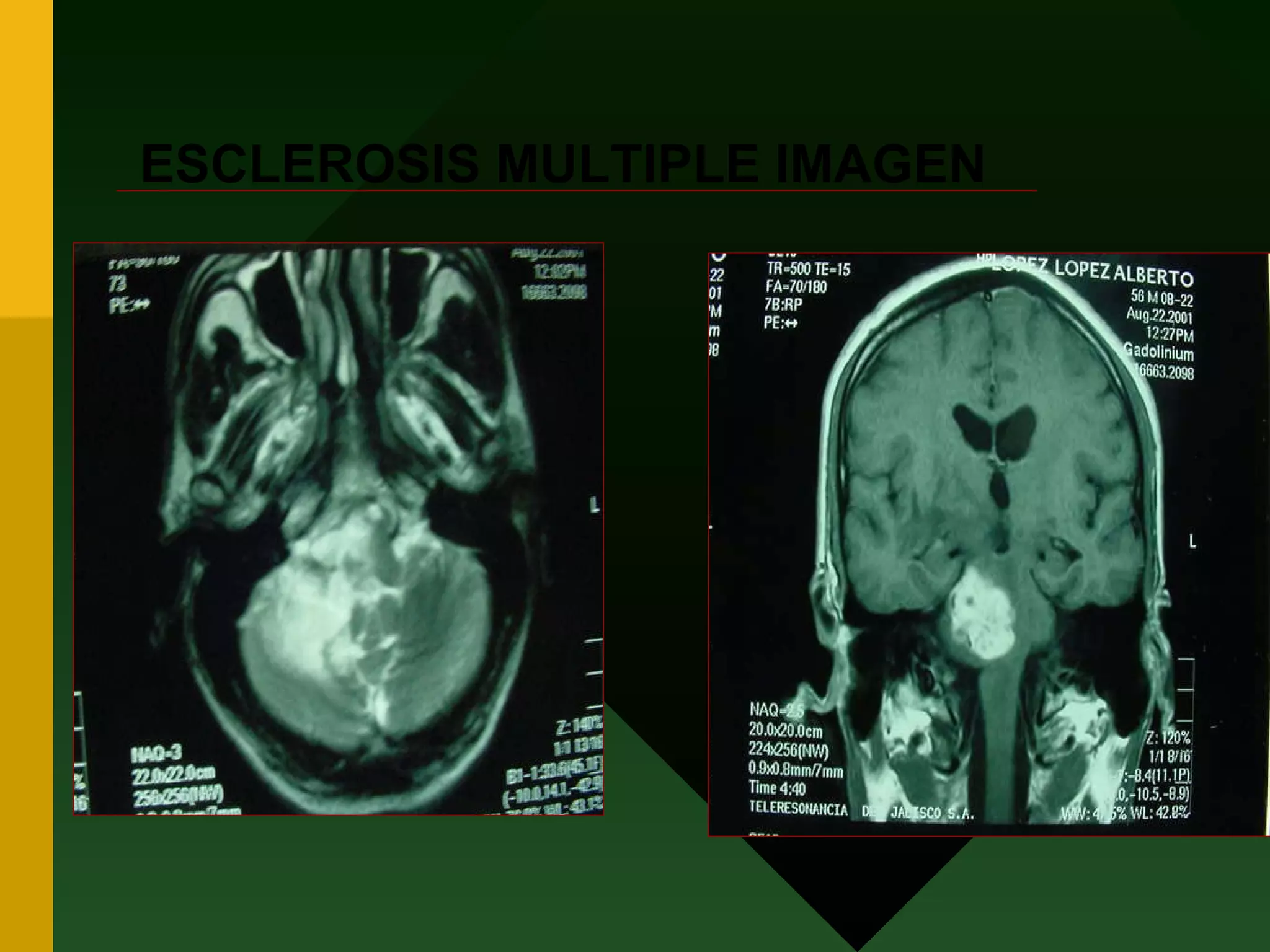 ESCLEROSIS MULTIPLE IMAGEN 