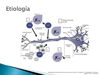 Ag latentes VEBAc específicos VEB
Auto Ag/M/Ax
Reacción X
Enfermedades desmielinizantes del sistema nervioso central O. Fernández, V. E. Fernández y M. Guerrero -
Medicine. 2015;11(77):4601-9
 