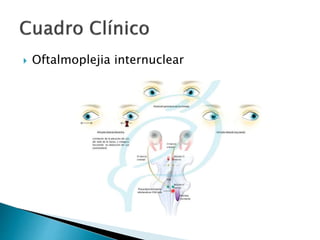  Oftalmoplejia internuclear
 
