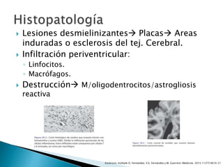  Lesiones desmielinizantes Placas Areas
induradas o esclerosis del tej. Cerebral.
 Infiltración periventricular:
◦ Linfocitos.
◦ Macrófagos.
 Destrucción M/oligodentrocitos/astrogliosis
reactiva
Esclerosis múltiple O. Fernández, V.E. Fernández y M. Guerrero-Medicine. 2015;11(77):4610-21
 