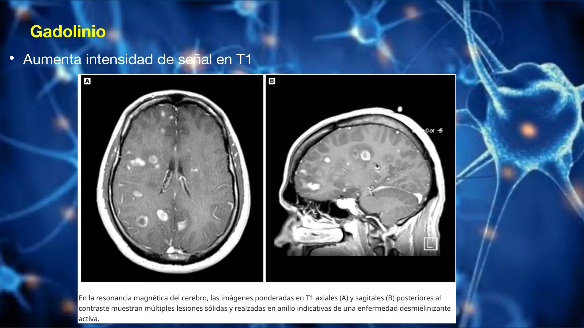 Gadolinio
• Aumenta intensidad de señal en T1
 