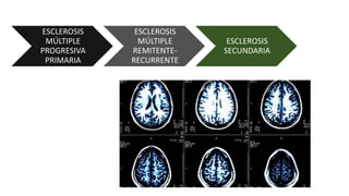 ESCLEROSIS
MÚLTIPLE
PROGRESIVA
PRIMARIA
ESCLEROSIS
MÚLTIPLE
REMITENTE-
RECURRENTE
ESCLEROSIS
SECUNDARIA
 