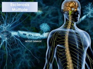 Esclerosis
Múltiple
 