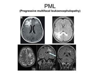PML ( Progressive multifocal leukoencephalopathy) 