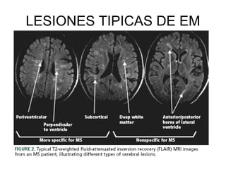 LESIONES TIPICAS DE EM 