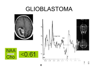 GLIOBLASTOMA 