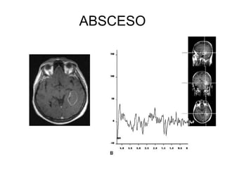 ABSCESO 