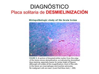 DIAGNÓSTICO Placa solitaria de  DESMIELINIZACIÓN 