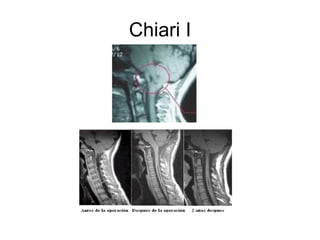 Chiari I 