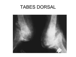 TABES DORSAL 