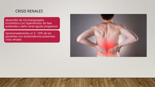 CRISIS RENALES
desarrollo de microangiopatía
trombótica con hipertensión de fase
acelerada y daño renal agudo progresivo
Aproximadamente un 5 -10% de los
pacientes con esclerodermia presentan
crisis renales
 