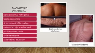 DIAGNÓSTICO
DIFERENCIAL
fibrosis sistémica nefrogénica
fascitis eosinofílica
síndrome eosinofilia-mialgia
enfermedad injerto vs huésped
porfiria cutánea tardía
Escleromixedema
Escleroderma adultorum
 