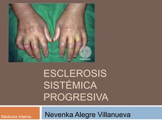 ESCLEROSIS 
SISTÉMICA 
PROGRESIVA 
Medicina Interna Nevenka Alegre Villanueva 
II 
 