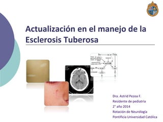 Actualización en el manejo de la
Esclerosis Tuberosa
Dra. Astrid Pezoa F.
Residente de pediatría
2° año 2014
Rotación de Neurología
Pontificia Universidad Católica
 