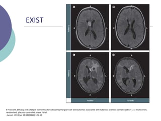 EXIST
9 Franz DN, Efficacy and safety of everolimus for subependymal giant cell astrocytomas associated with tuberous sclerosis complex (EXIST-1): a multicentre,
randomised, placebo-controlled phase 3 trial.
, Lancet. 2013 Jan 12;381(9861):125-32
 