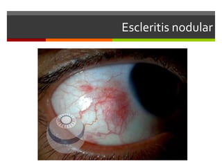 Escleritis nodular

 