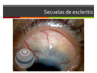 Secuelas de escleritis

 