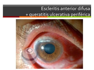 Escleritis anterior difusa
+ queratitis ulcerativa periférica

 