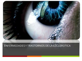 ENFERMEDADES Y TRASTORNOS DE LA ESCLEROTICA

 