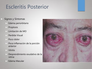 Escleritis Posterior
 Signos y Síntomas
 Edema periorbitario
 Proptosis
 Limitación de MO
 Perdida Visual
 Poco dolor
 Poca inflamación de la porción
anterior
 Vitritis
 Desprendimiento exudativo de la
retina
 Edema Macular
 